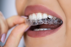 How Much Is Invisalign A Month in Belmont, MA? How Much Is Invisalign A Month in Belmont, MA?