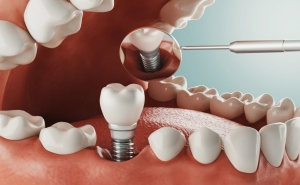 A Dental Implant  A Dental Implant